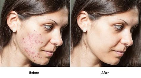 Accutane Side Effects: Isotretinoin Facts & Treatment Preparation