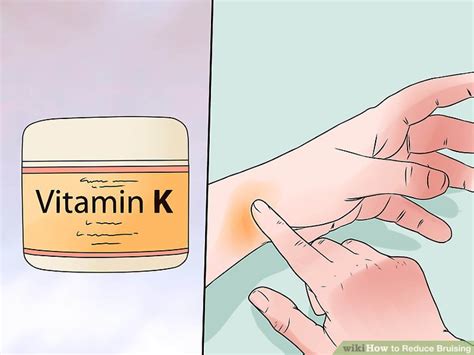 3 Ways to Reduce Bruising - wikiHow