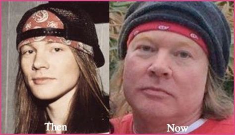 Axl Rose Plastic Surgery Before and After Photos - Latest Plastic ... #plasticsurgery #cosmeti ...