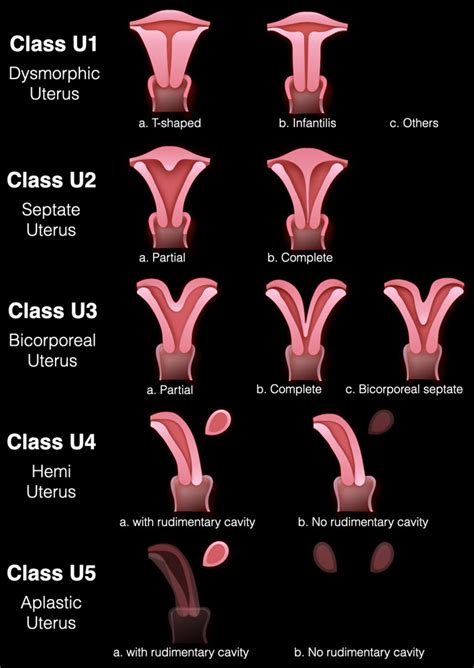 The Radiology Assistant : Müllerian duct anomalies