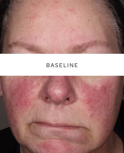 Visible rosacea relief | EPSOLAY (benzoyl peroxide) cream, 5%