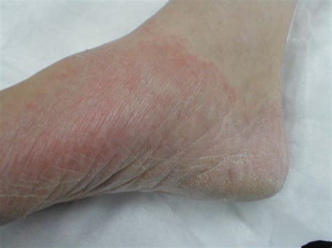 Tinea Pedis: Scaly red erruption of the feet caused ... | GrepMed