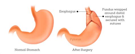 Nissen Fundoplication – GBMC Jordan