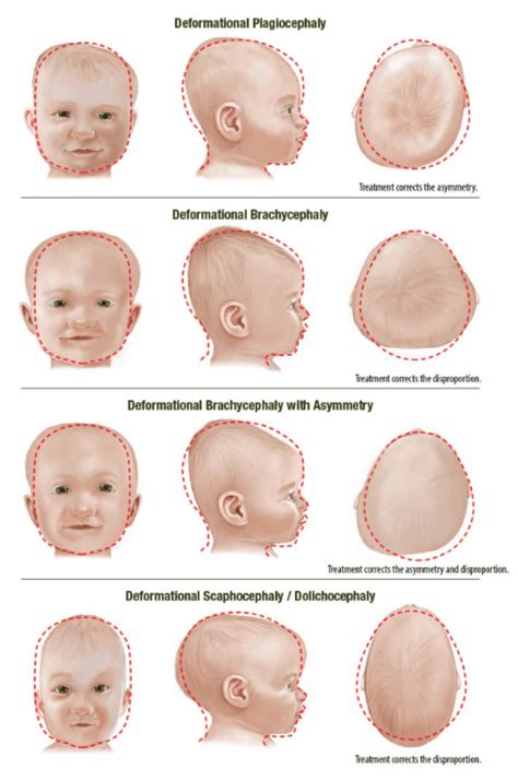 Scaphocephaly