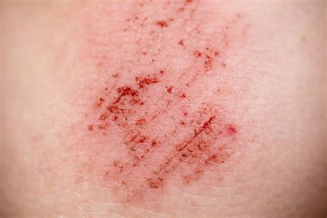 Cuts and grazes | NHS inform