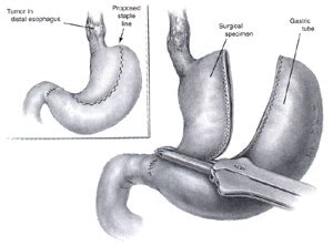 Transhiatal Esophagectomy | CTSNet