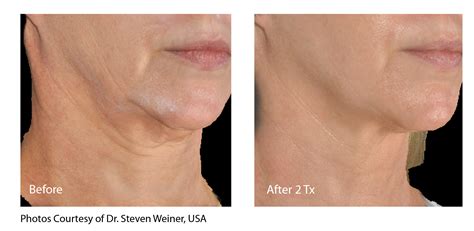 Thermage For Neck Before And After | Pea-vie