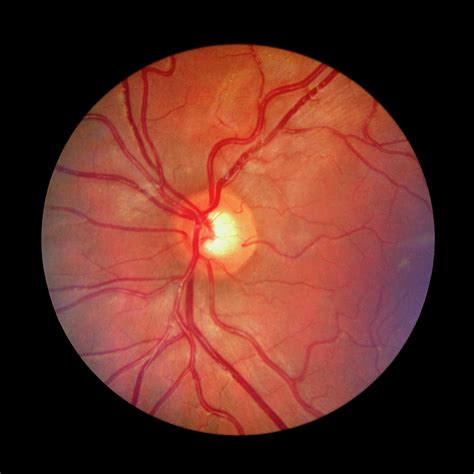 Fundus Camera Image Of A Normal Retina Photograph by Rory Mcclenaghan/science Photo Library - Pixels