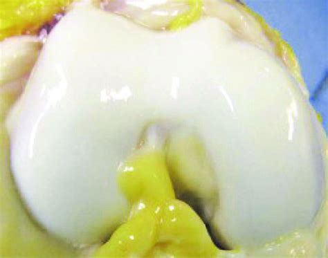 Gross image of articular cartilage on the femoral condyle of a healthy... | Download Scientific ...