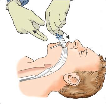 Oropharyngeal Airway Insertion and Care | Nurse Key