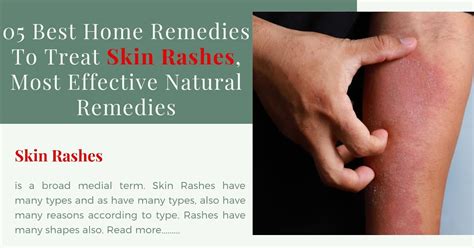 05 Best Home Remedies To Treat Skin Rashes, Most Effective Natural Remedies