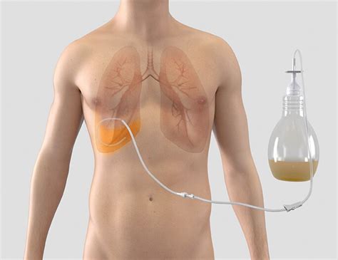 PleurX™ Catheter System Celebrates 20 Year Anniversary