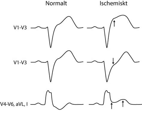 x-sgarbossa – ECG learning