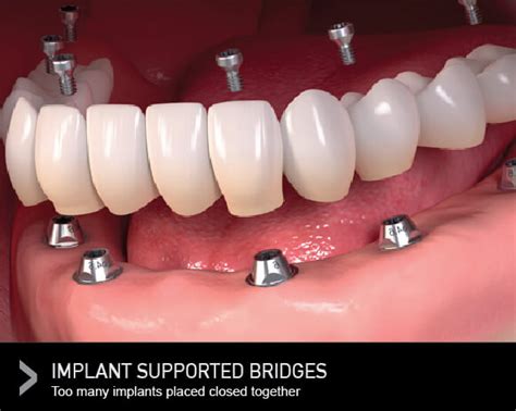 Puentes dentales: ¿Por qué elegir un puente dental en lugar de un implante dental? | Tea Band