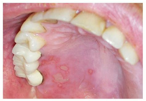 Recurrent Herpetic Stomatitis