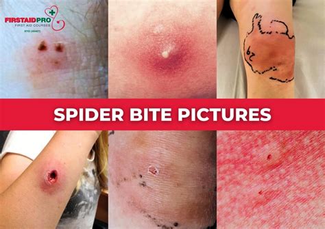 Spider bites - When to worry, Symptoms & First Aid