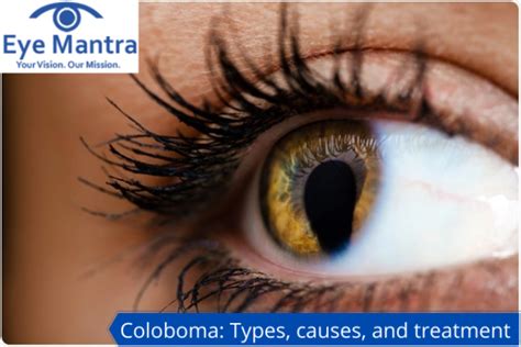 Coloboma- A Complete Guide | Eyelid Coloboma Surgery