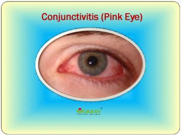 PPT – Conjunctivitis (Pink Eye): Symptoms, Causes, Treatment and more (1) PowerPoint ...