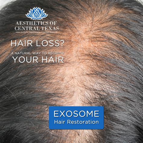 Supercharge Hair Restoration with Exosomes for Best Results - Aesthetics of Central Texas by Dr ...