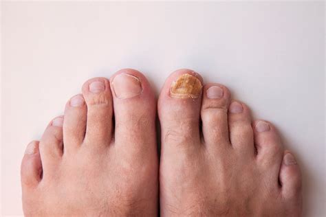 Feet Fungus Pictures, Toenail Fungus Treatment Orlando Foot Ankle Associates Of Florida ...