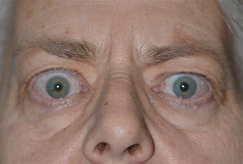 Thyroid Eye Disease Presenting Symptoms - vrogue.co