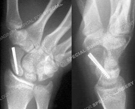 Scaphoid Fractures - Orthopedic Trauma Service