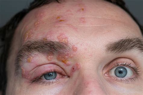 Shingles on the Face: Symptoms, Causes, and Treatments | MyVision.org