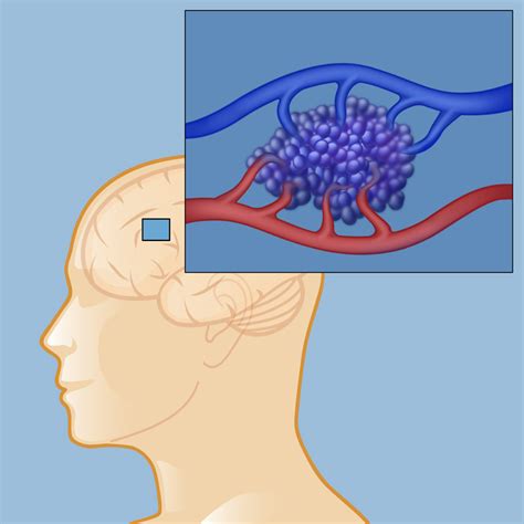 Cavernous Malformations | Weill Cornell Brain and Spine Center