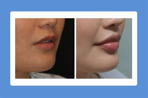 Lip Lift - What Should You Know Before Opting For A Lip Lift Surgery ...