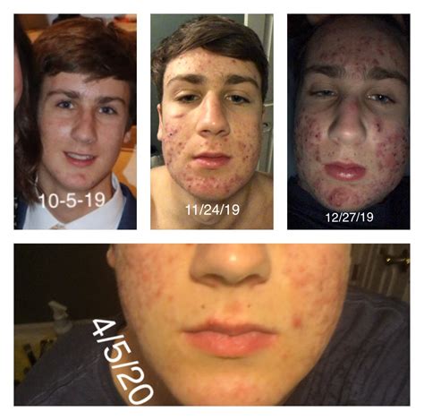 Permanent scars from acne fulminans caused by accutane : r/AccutaneDamage