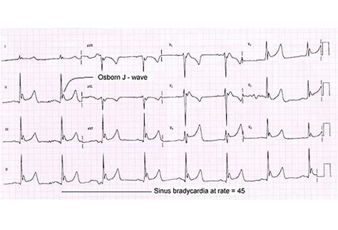 ekg results low oxygen - EliasMartinson's blog