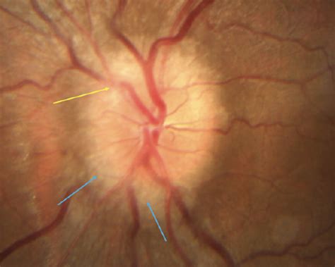 Papilledema or Pseudopapilledema? - Modern Optometry