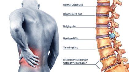 Right Side Back Pain: Causes and Treatment