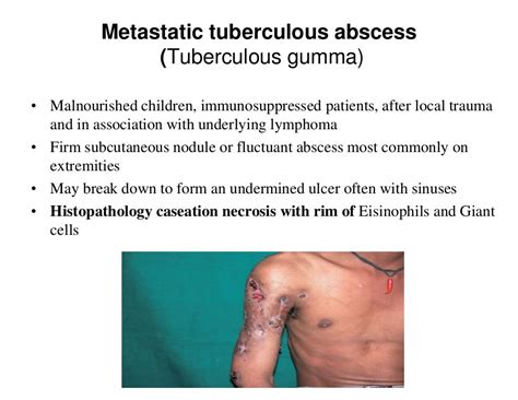 cutaneous tuberculosis