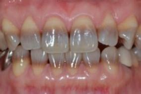 tooth discoloration caused tetracycline