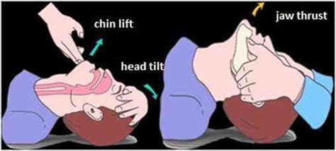 Cardiopulmonary Resuscitation (CPR): A simple life saving measure that everyone must know