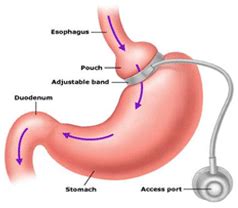 Vertical Banded Gastroplasty Before And After