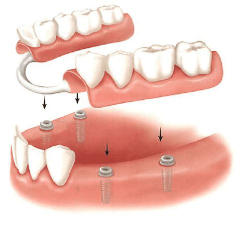 Implant Supported Removable Partial Denture