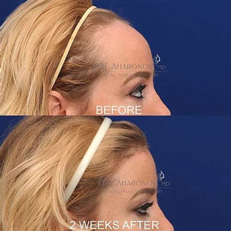 Hairline Lowering Surgery | Plastic Surgery