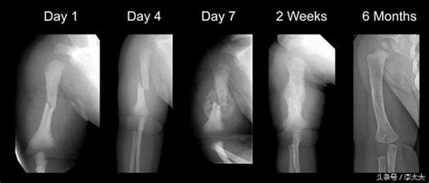 腦洞大開：骨頭斷了怎麼長回來！專業釋疑！健康指導！ - 每日頭條