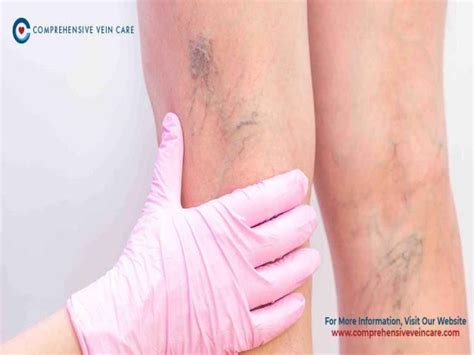 Sclerotherapy for varicose veins | Comprehensive Vein Care