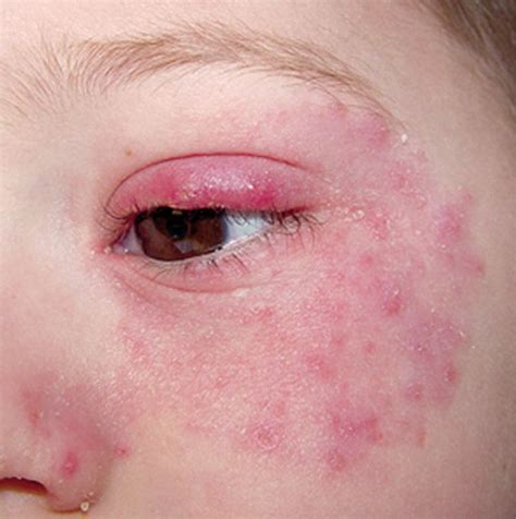 Periocular Rash Clinical Challenge: What would you do next? | Eczema ...