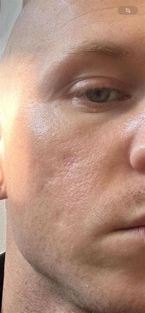 Rolling scars after dermal fillers : r/AcneScars