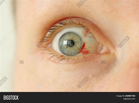 Bloodshot Eye. Woman With Burst Blood Vessel In Eye. Very Red Bloody ...