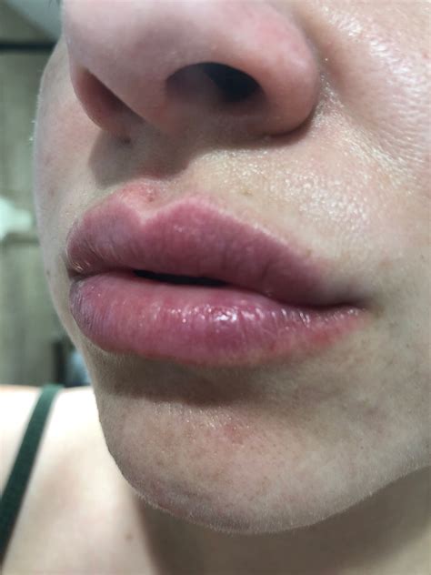 Pics Of Allergic Reaction On Lips | Lipstutorial.org