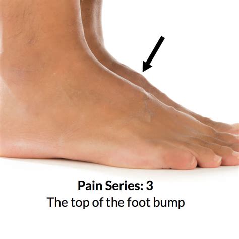 Sprain On The Top Of The Foot Hot Sale | emergencydentistry.com