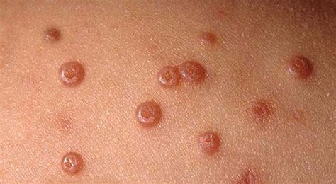 Molluscum Contagiosum Scar Treatment