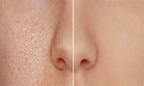 Get rid of large pores at Vardaan Clinic