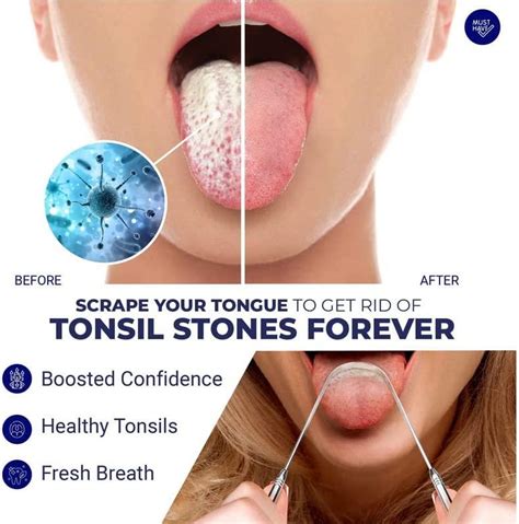 ORAVIX Tonsil Stone Remover| Tonsil Stone Removal kit| Easy Home Tonsil Stone Treatment ...