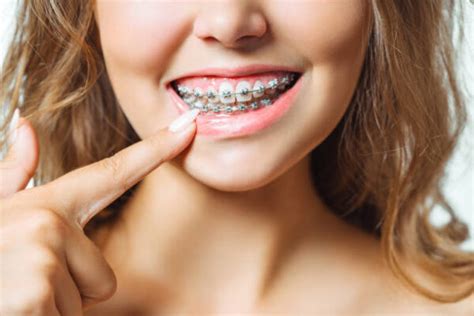 Dental Braces: Procedure, Types and Results - REPC